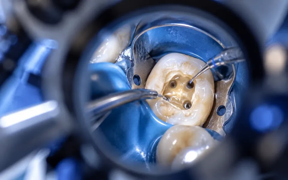 Zahnarzt behandelt einen Backenzahn unter dem dentalen OP-Mikroskop